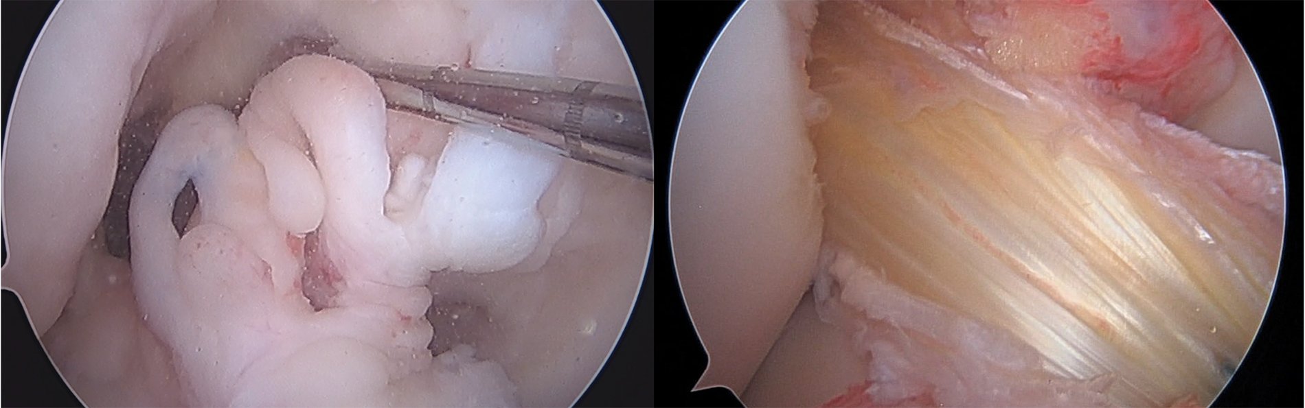 ACLreconstruction