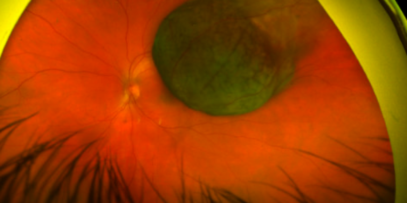 Scott-oliver-ocular-melanoma-marker-2025