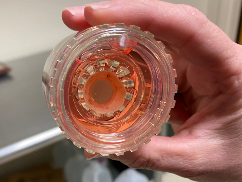 Improved Treatment Technique for Fuchs’ Dystrophy Shows Promise