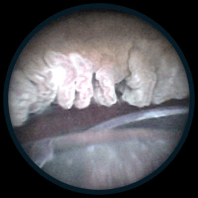 A close-up view of a procedure being done on eye tissue.