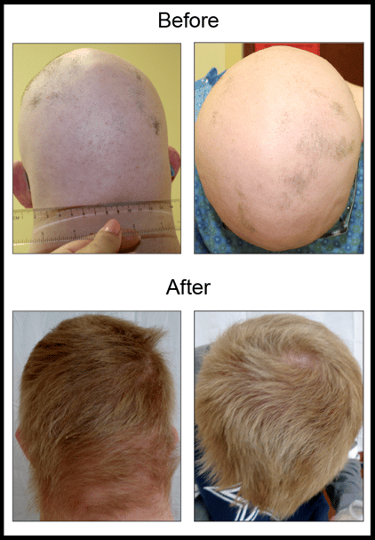 Before and After images of a clinical trial participant with alopecia areata experiencing successful hair regrowth 