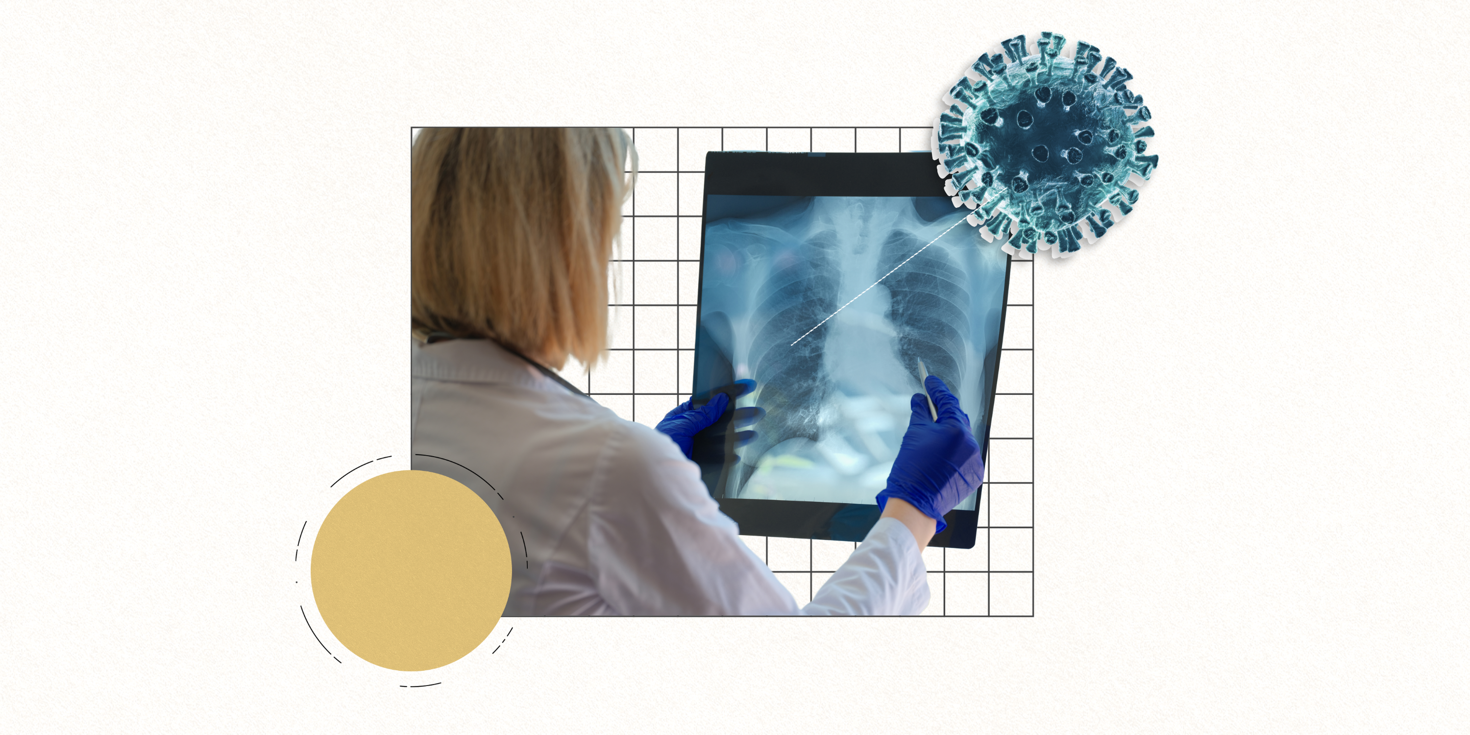 Respiratory Viruses Can Wake Up Breast Cancer Cells in Lungs