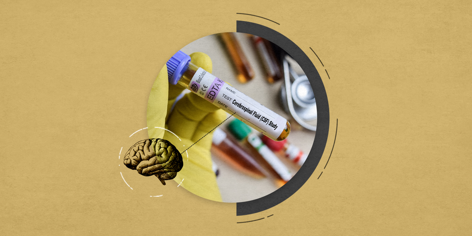 Cerebral-Spinal Fluid Molecular Test Improves Early and Accurate Diagnosis of Multiple Sclerosis