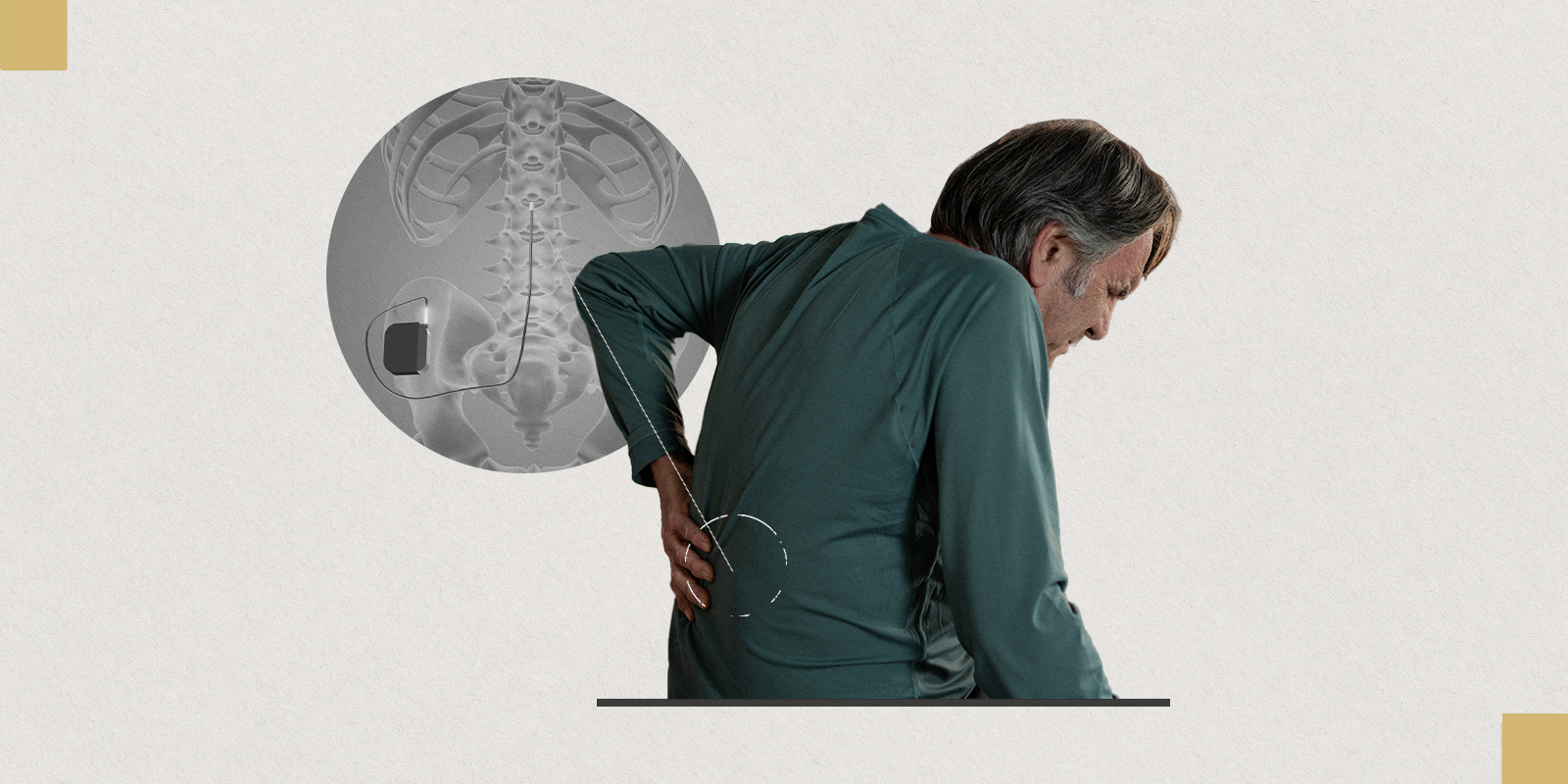 X-ray shows placement of spinal stimulator next to an image of an older man with back pain. 