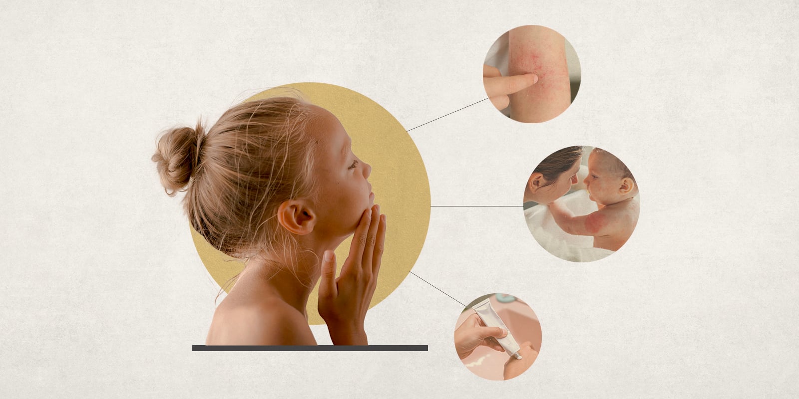 Stylized image of a young girl touching her chin with breakout photos of various phases and treatments of eczema.