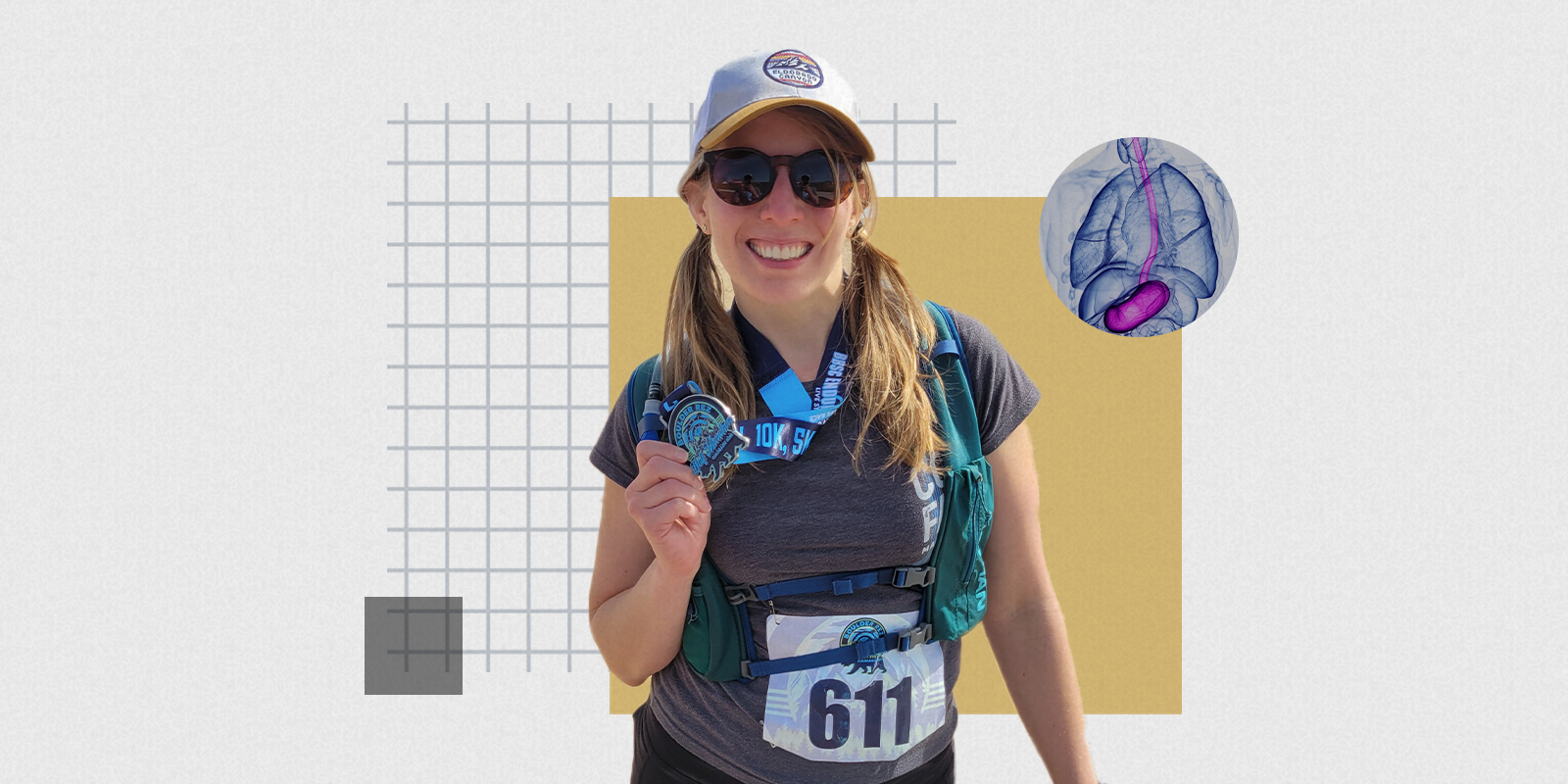 Megan Perea has idiopathic subglottic stenosis, and here she holds a medal from a half marathon 