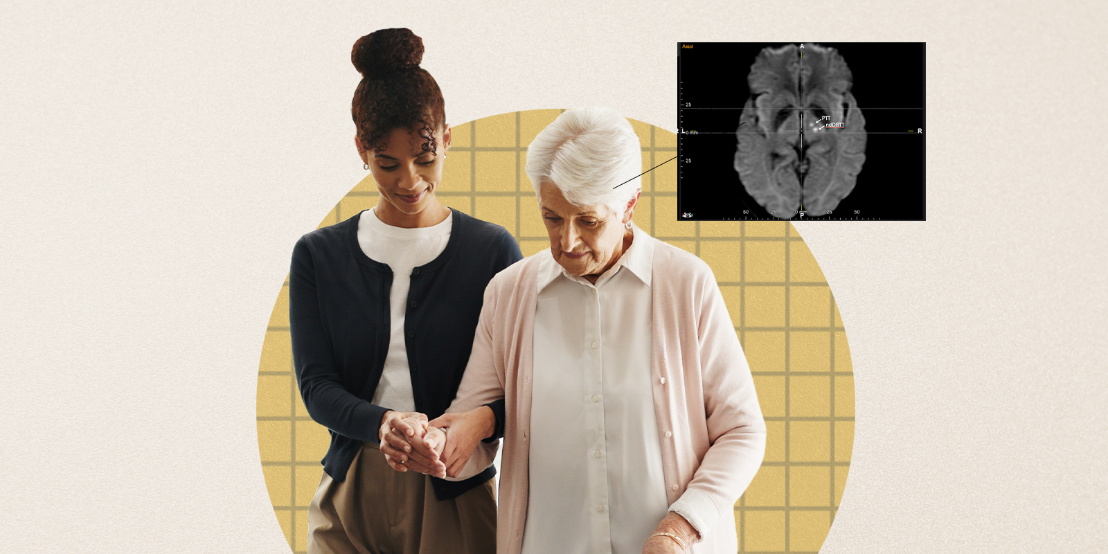 An image of a woman who received dual-target focused ultrasound treatment for advanced Parkinson's gets help walking. 