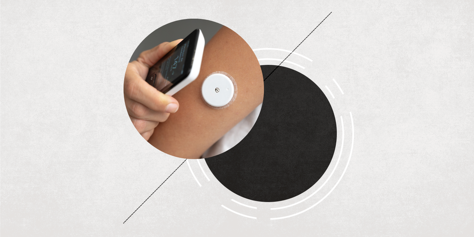 A handheld smart phone hovers near a continuous glucose monitor on a person's arm