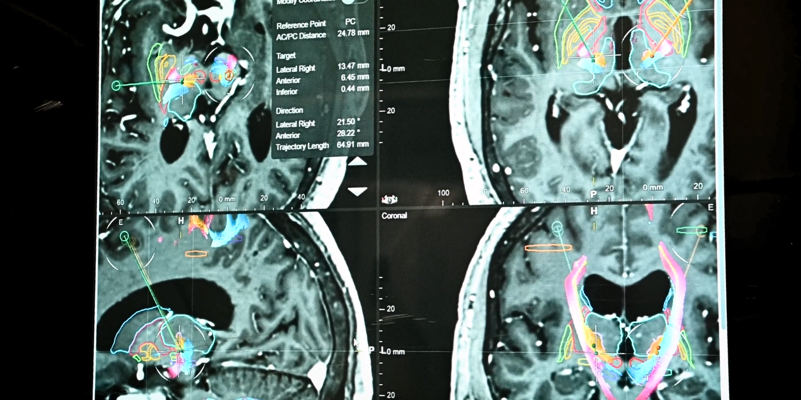 A brain scan illuminating targeted areas during a deep brain stimulation surgery for obsessive&nbsp;compulsive disorder at CU Anschutz.