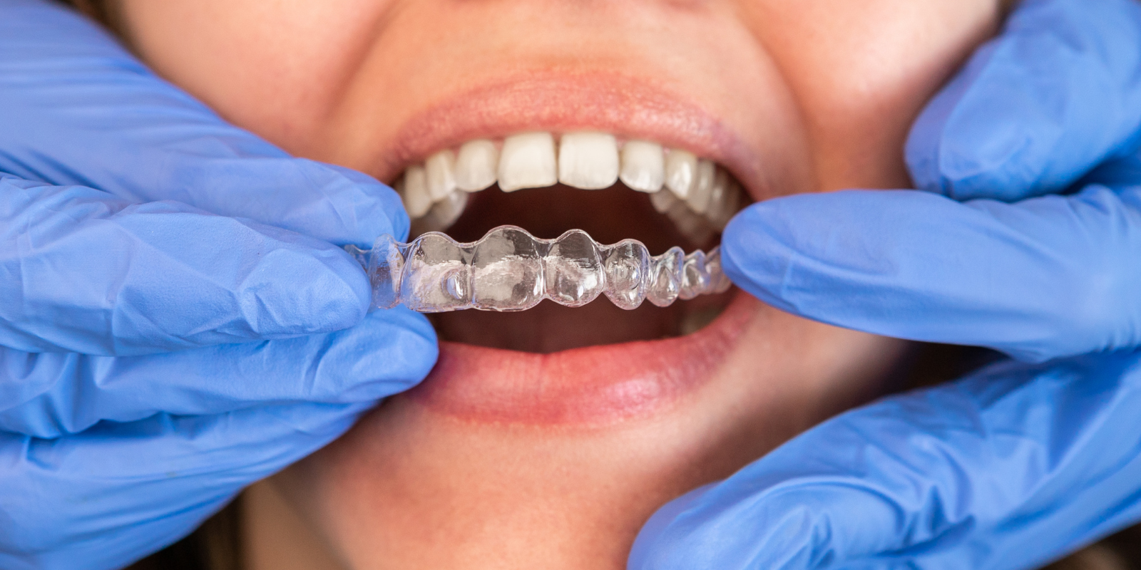 dentist fitting aligner appliance in patient's mouth 
