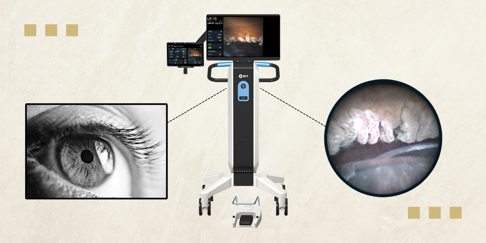 A graphic image featuring a tall ophthalmology machine, a picture of a person's eye, and a close-up image of the ciliary processes in the eye.