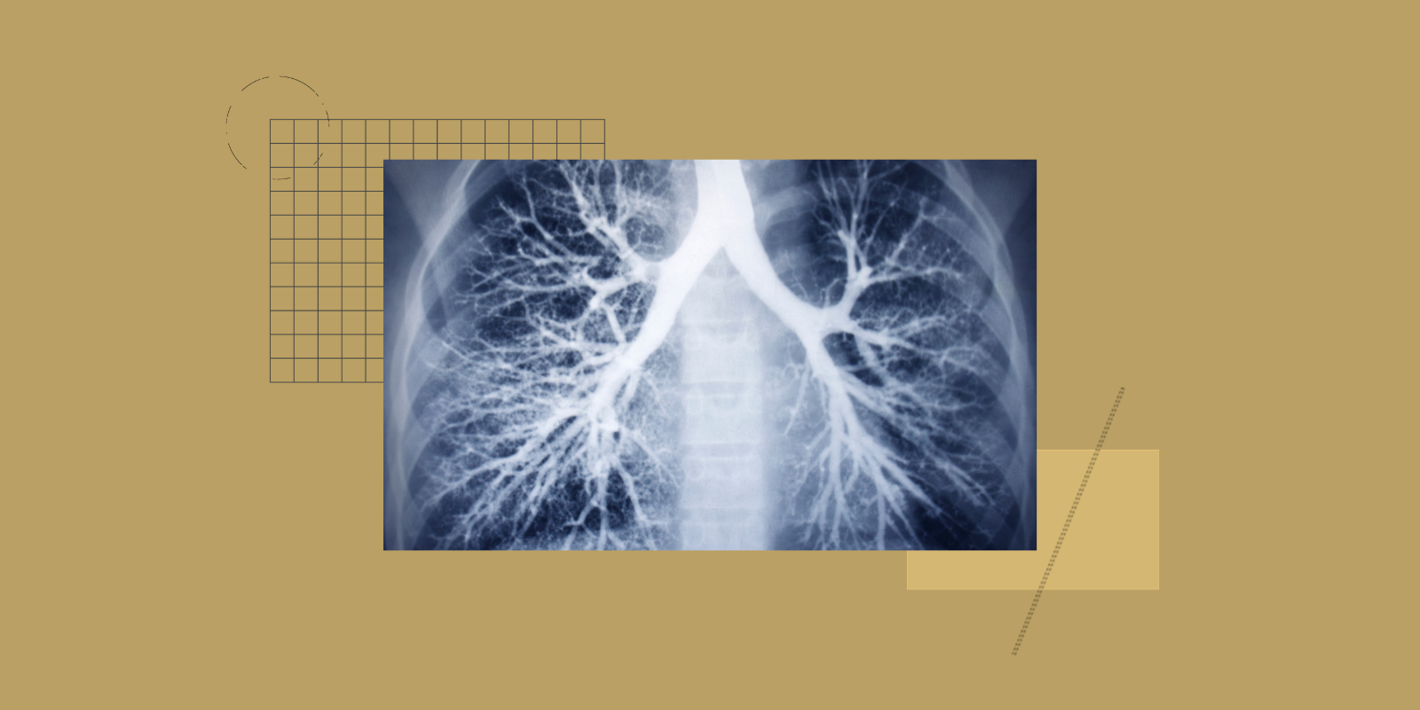 X-ray of lungs showing airways