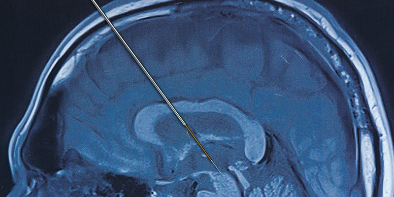 Deep brain stimulation is shown with an electrode placed in a scan of a brain. 