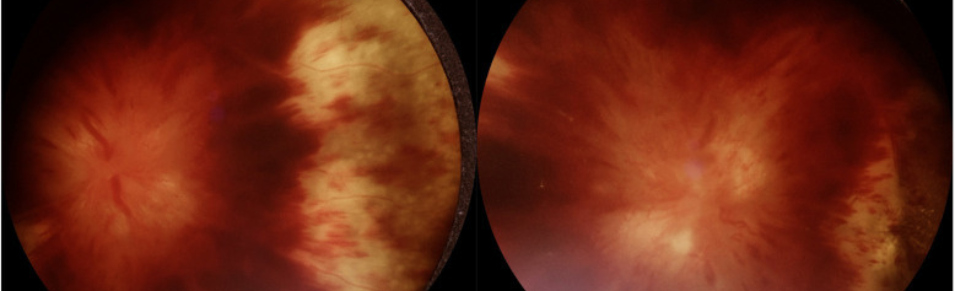 Employing Portable Fundus Photography Cameras to Enhance On-Call Imaging