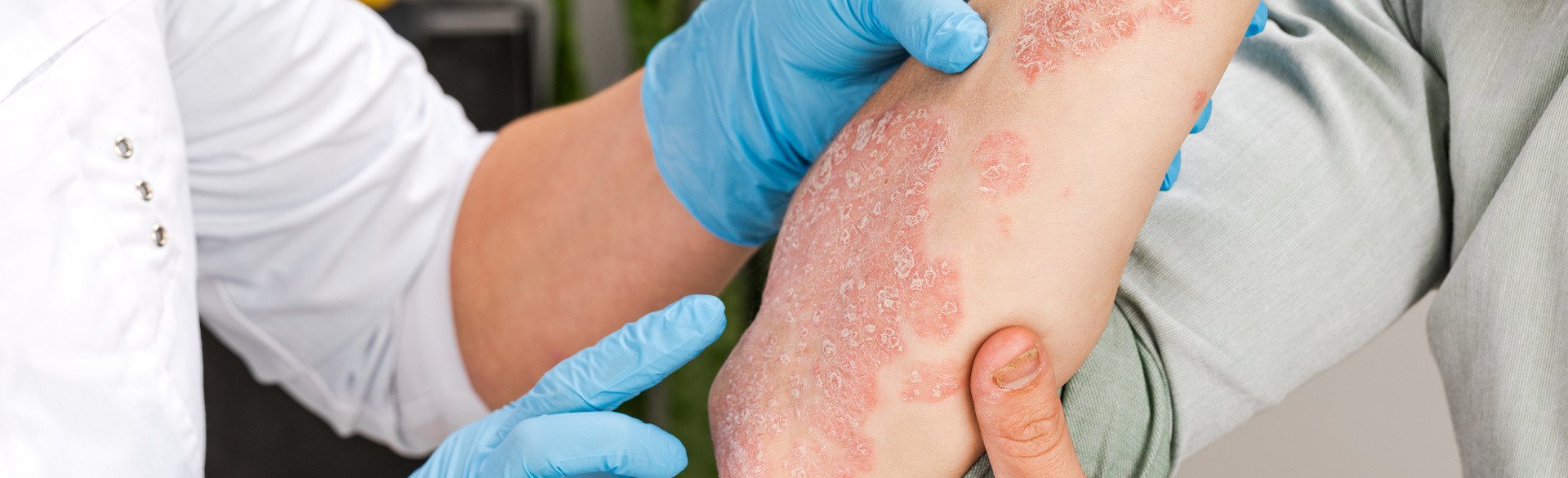 Doctor examining a person's psoriasis on their arm