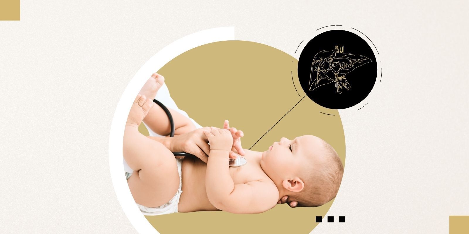 A photo of a baby clad in a diaper only gazing up at a provider who is positioning a stethoscope on baby's bare chest with a grapic overlay of a liver above.