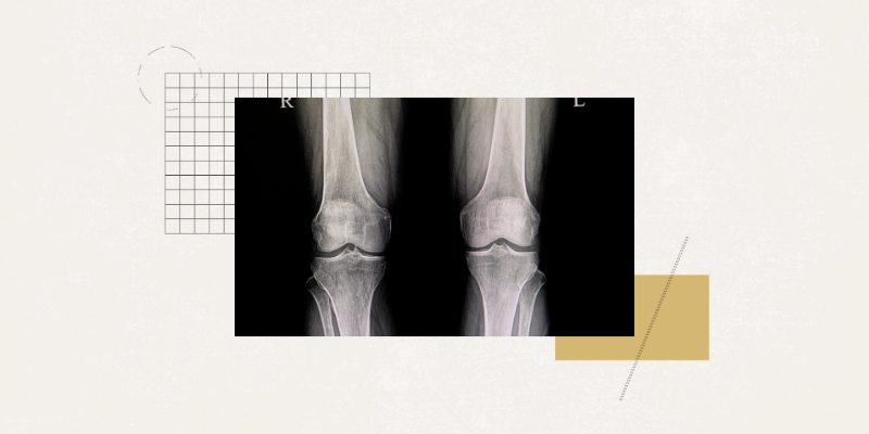 Graphic of an X-ray of knees