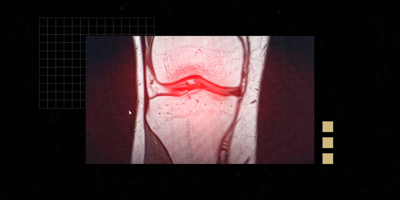 Image of a knee joint x-ray showing presence of osteoarthritis 