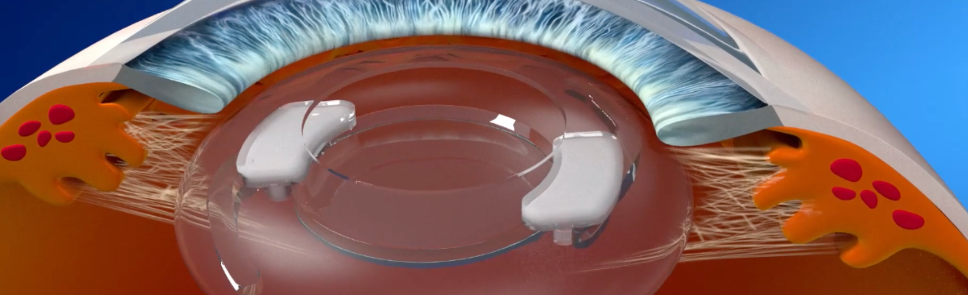 Drug Delivery Platform Developed by CU Ophthalmologist Shows Promise for Glaucoma Patients