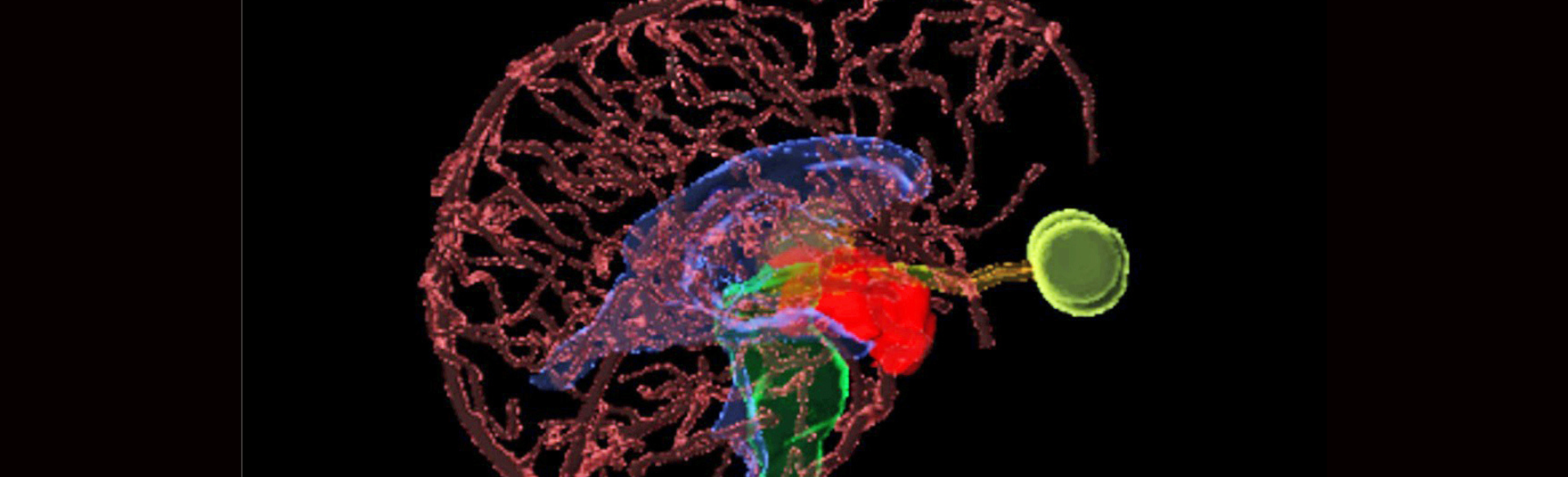 Image of an adamantinomatous craniopharyngioma (ACP) tumor 