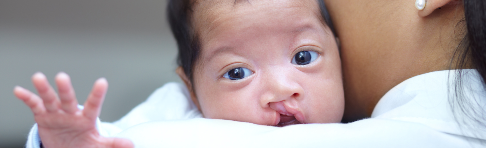 A grant from Align Technologies will support  Lowe in developing more efficient ways to treat infants with cleft lip and palate.