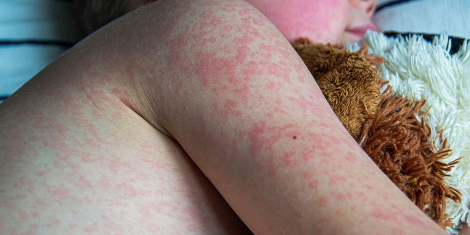 Close-up shot of a baby with a spotty rash hugging a teddy bear. 