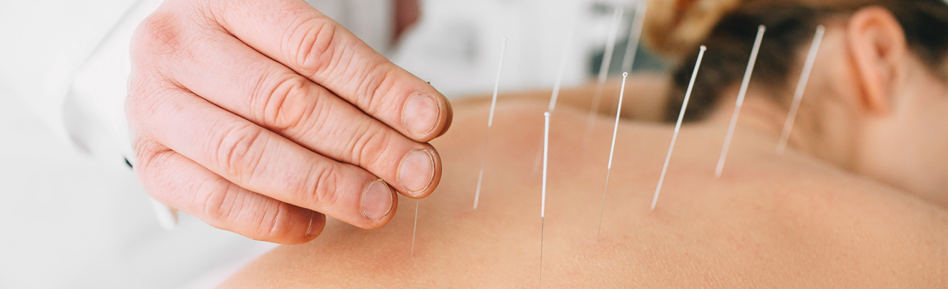 person receiving acupuncture