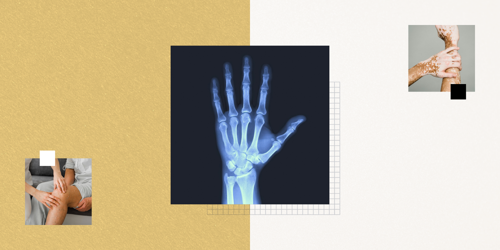 Image showing patient with knee pain, X-ray of hand, hand and arm with vitiligo